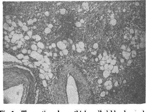 Figure 1 From Renal Angiomyolipoma Causing Fatal Retroperitoneal