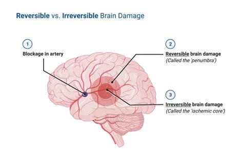 Brain Damage: Definition, Types, and Causes I NotesBard