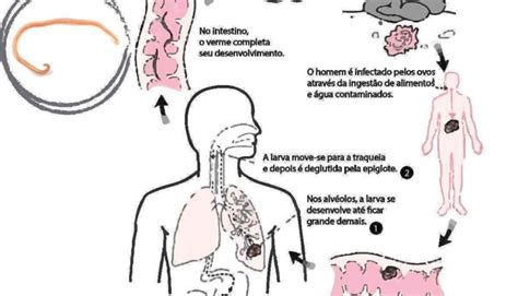 Agente Causador Da Ascaridíase - Ascaridíase - O que é, ciclo, transmissão, sintomas, prevenção, tratamento