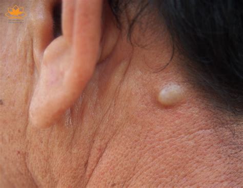 U nang Epidermoid u nang bã nhờn Công ty TNHH Dược Mỹ Phẩm Sen Vàng