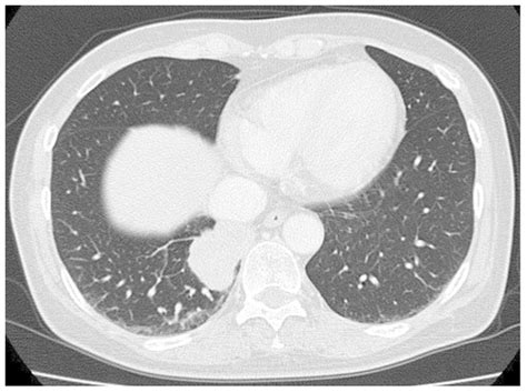 Chest Computed Tomography Scan At The Time Of First Admission Showing A