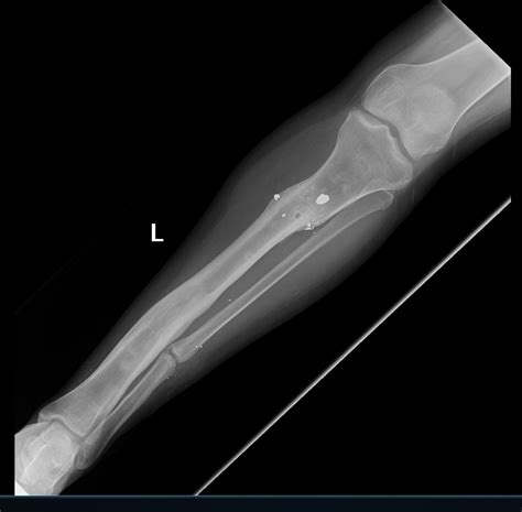 Osteomyelitis Adult Dr Mohamed Attia M D PhD