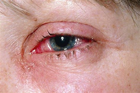 Pinkeye Conjunctivitis Causes Symptoms Treatments Artofit