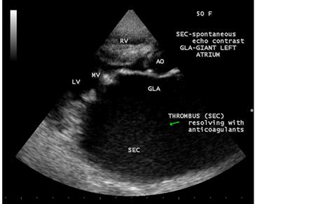 Rheumatic Giant Left Atrium—an Overview