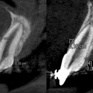 Measurement Of The Labial And Palatal Alveolar Bone Heights On