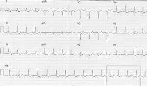 Alteraciones electrocardiográficas en gestantes a propósito de un caso