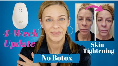 Newa Beauty Radio Frequency Device Before And Afters No Botox No