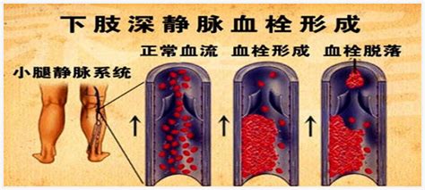 防治静脉血栓栓塞症，我们一直在行动！