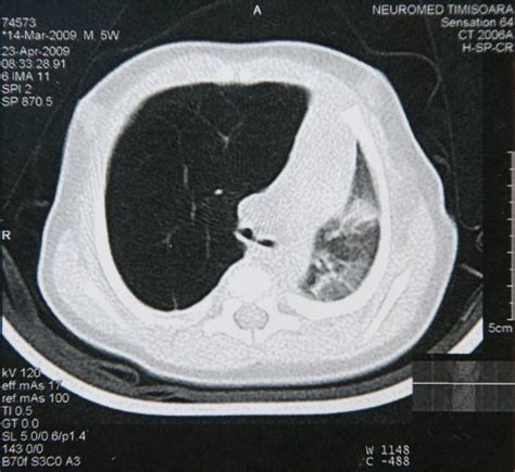 Figure 3 From CONGENITAL LOBAR EMPHYSEMA CLE RADIOLOGIC AND