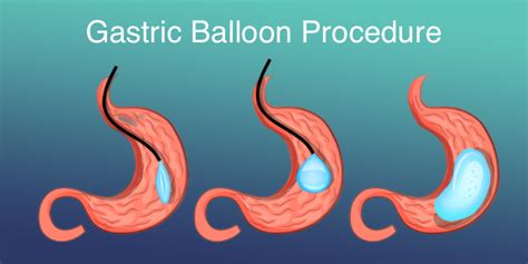 Gastric Balloon Surgery