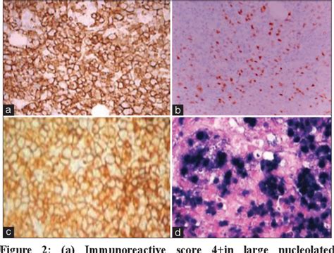 Epstein Barr Virus Positive Diffuse Large B Cell Lymphoma Not