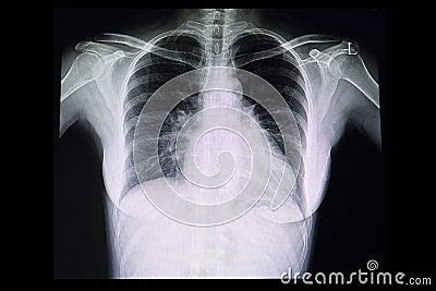 A Chest X Ray Film Of A Patient With Cardiomegaly Royalty Free Stock