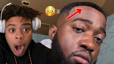 Jidion Gets His Hairline Back With Insane Hairline Surgery Must Watch