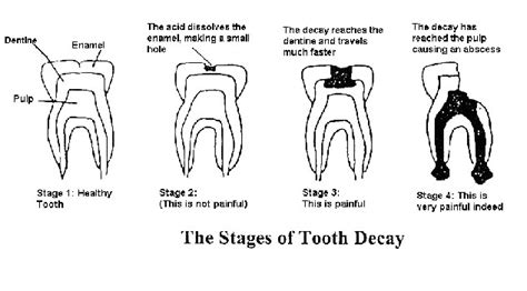 Microbewiki:''Streptoccus mutans'' and Dental Caries - microbewiki