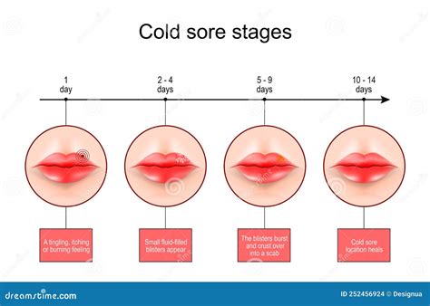 Cold Sore Stages. Lips with Symptoms of Herpes Labialis Stock Vector ...