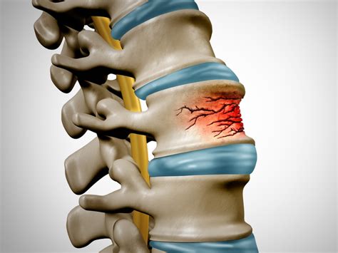 Kyphoplasty Surgical Procedure - Coastal Health Specialty Care