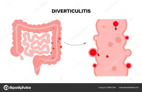 Divertikulitis Und Divertikulose Divertikeln Den W Nden Des Darms