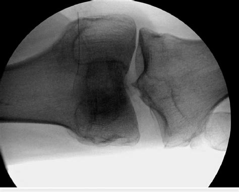 Example Fluoroscopic Image Of Varus Stress Testing Where Lateral Download Scientific Diagram