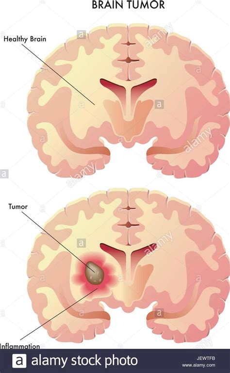 Glioma Symptoms And Causes Artofit