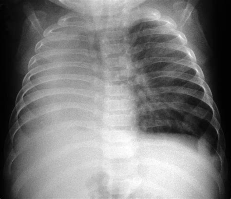 Chest X Ray Showing A Complete Opacity Of The Right Lung With Mild Download Scientific Diagram