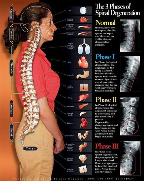 3 Phases Of Care Poster Spinal Degeneration Degenerative Disc