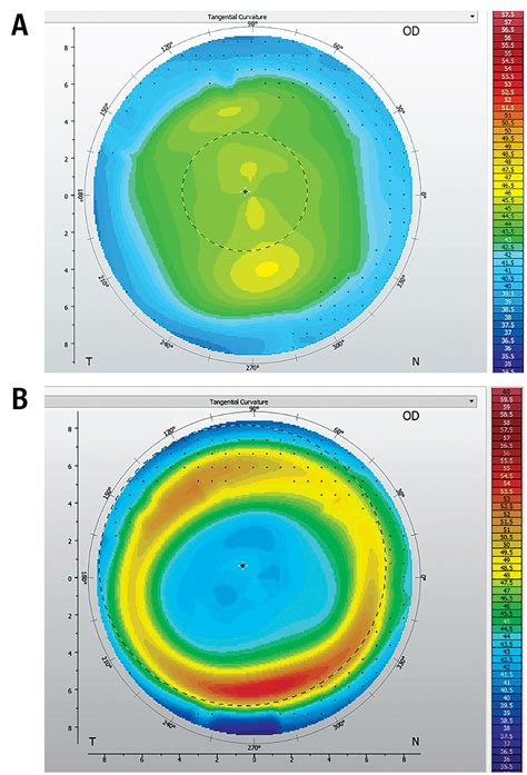 Orthokeratology Today Contact Lens Spectrum