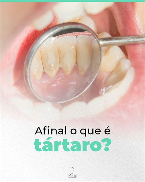 Afinal o que é tártaro Odontologia Perfil