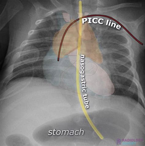 Picc Line Xray