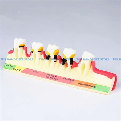 Ada Periodontal Classification Chart