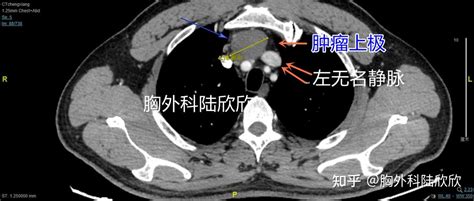 剑突下胸腔镜手术切除前纵隔9厘米胸腺肿瘤 知乎