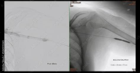 Angiogram Balloon Dialysis Catheter Inflated At Arteriovenous Av