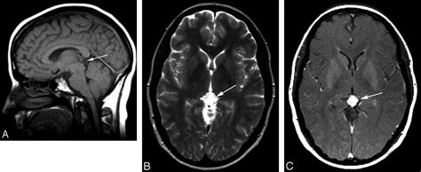 Pineal Gland Mri