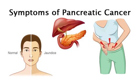 Pancreatic Cancer Wp WomenWorking