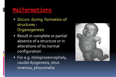 Ppt Birth Defects Powerpoint Presentation Free Download Id 5047175