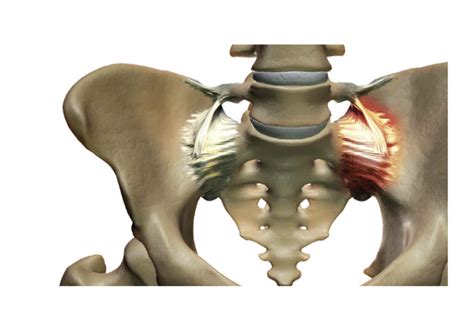 SI Joint Pain | Sonospine