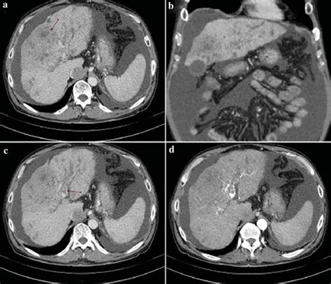 Diffuse hepatocellular carcinoma. The examination in portal-venous ...