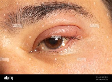 Stye Upper Eyelid Swollen