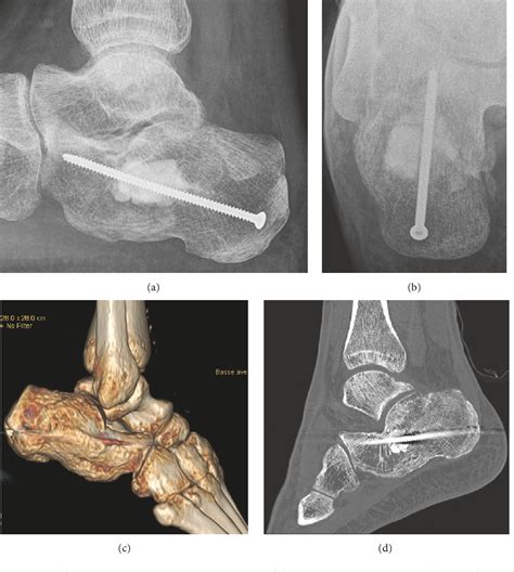 PDF A Novel Minimally Invasive Reduction Technique By Balloon And