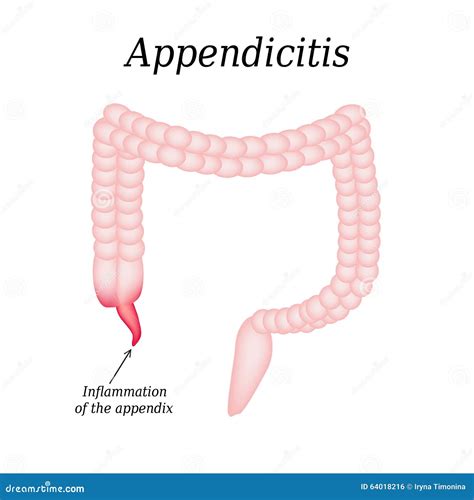 Appendicitis Inflammation Of The Appendix Colon The Illustration On