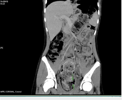 Figure 1 From The Extremes Of Constipation A Case Of Stercoral Perforation From Fecal Impaction