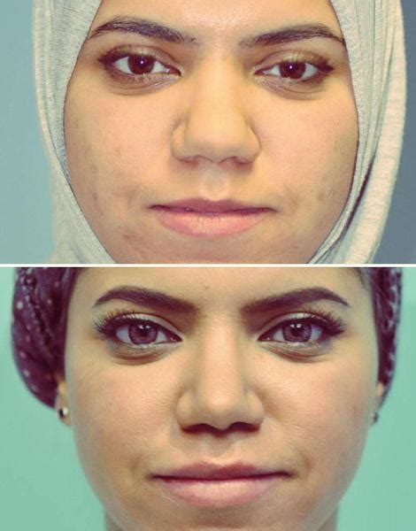 Bulbous Nose Job Before And After » Rhinoplasty: Cost, Pics, Reviews, Q&A