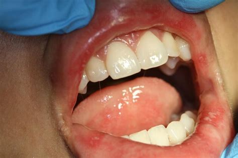 Aphthous Stomatitis Medical Office Pediatria Domani Of Dr Leandro