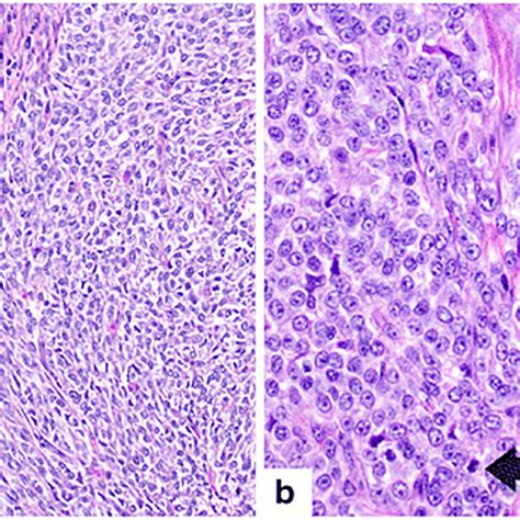 A The Tumor Composed Of Nests Separated By Thin Fibrous Septa Tumor