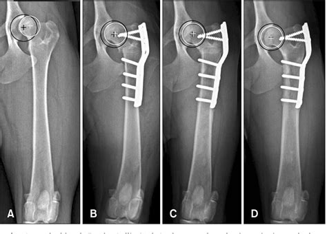 Figure From Effects Of Intertrochanteric Varus Osteotomy On Norberg