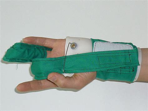 Composite Flexion Splint For The Stiff Hand Journal Of Hand Therapy