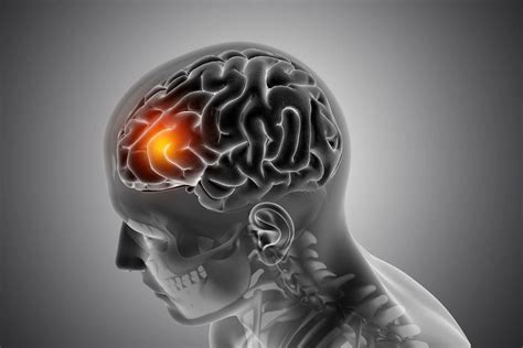 Salud Cerebral Y Acv Cómo Prevenir La Patología Que Afecta A 1 De Cada 4 Personas En El Mundo