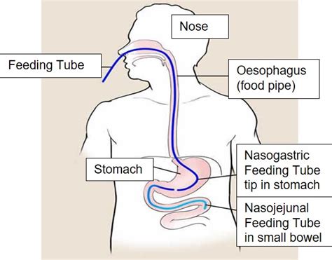 Nasal Tube Feeding North Tees And Hartlepool NHS Foundation Trust