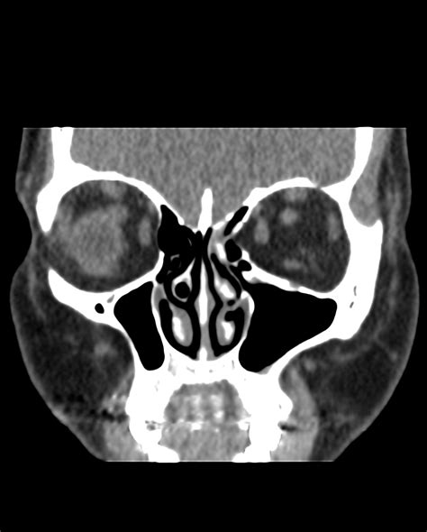 Lamina Papyracea Dehiscence Image