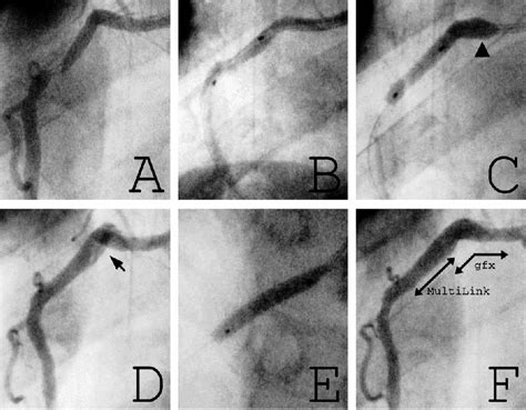 Figure 1 From Coronary Dissection Due To Overdilatation Of An Elastic