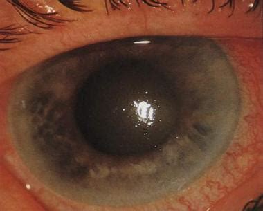 Causas de glaucoma primario de ángulo cerrado agudo